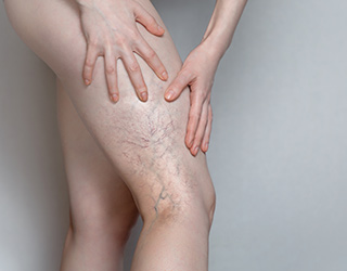 Testosterone, Anastrozole And Venous Thrombosis