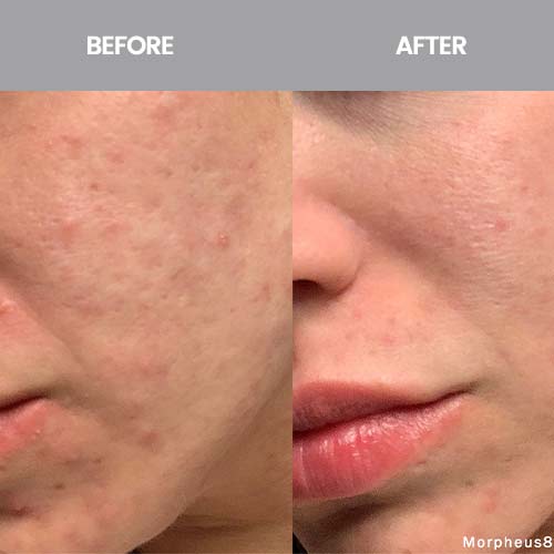 Morpheus8 Treatment Specialist Near Me in Scottsdale, AZ Morpheus8 Treatment Specialist Near Me in Scottsdale, AZ