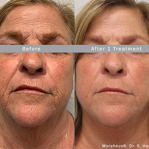 Morpheus8 Treatment Specialist Near Me in Scottsdale, AZ Morpheus8 Treatment Specialist Near Me in Scottsdale, AZ