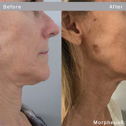 Morpheus8 Treatment Specialist Near Me in Scottsdale, AZ Morpheus8 Treatment Specialist Near Me in Scottsdale, AZ